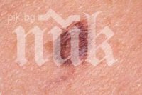 Как да се спасим от тъмни петна по кожата?