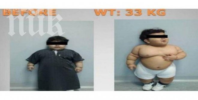 Двегодишно дете тежи 33 килограма