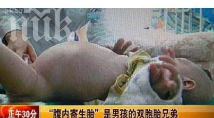 куриоз извадиха зародиш близнак корема годишен