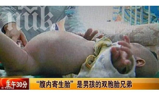 Куриоз! Извадиха зародиш на близнак от корема на 2-годишен