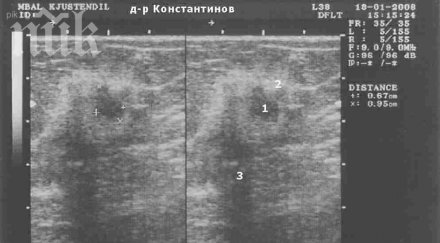 ехографията гърдите безвредна