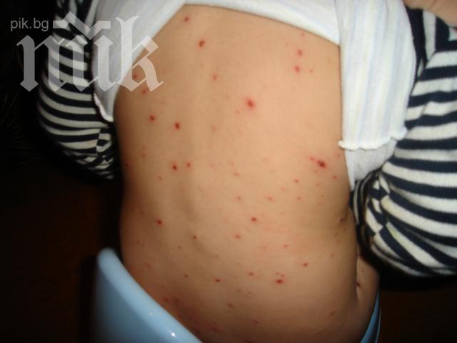 6 деца болни от варицела в Ловеч