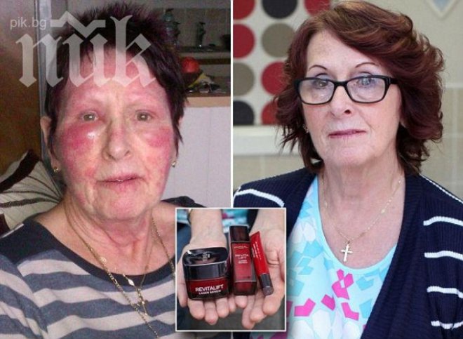 Ужасяващо! Крем против бръчки съсипа лицето на 66-годишна жена (снимки)