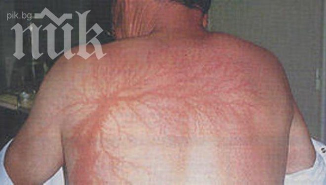 Лекар стана пианист след удар от светкавица