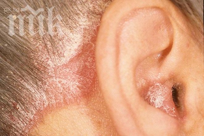 150 000 българи страдат от псориазис