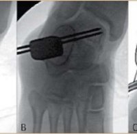 Лазерна терапия помага при артроза