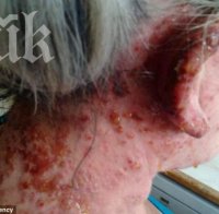 Ужасяваща алергична реакция! Боя за коса унищожи кожата на 56-годишна жена (снимки)