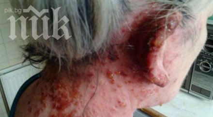 ужасяваща алергична реакция боя коса унищожи кожата годишна жена снимки
