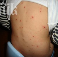 Бум на варицела в страната! За седмица от дребна шарка са се заразили 363 деца
