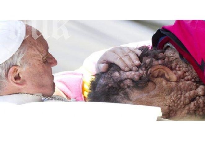 Папата целуна клетник, покрит с тумори по цялото тяло