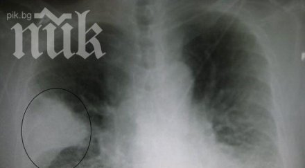 плашеща статистика всеки секунди едно дете умира пневмония