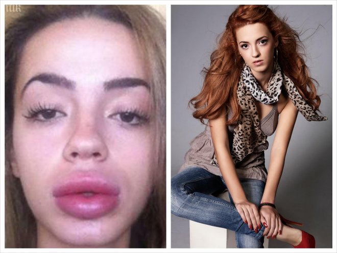 Претендентка за Мис България се обезобрази жестоко с козметична процедура