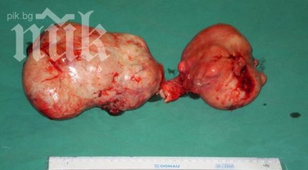 кошмар отстраниха тумор матката жена световен рекорд