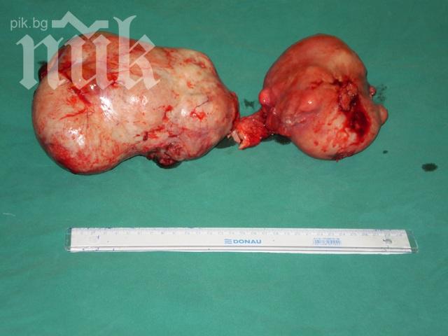 Кошмар! Отстраниха 24 кг тумор от матката на жена! Това е световен рекорд!