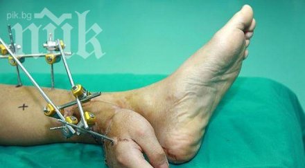 китайски хирурзи присадиха ръка крак видео