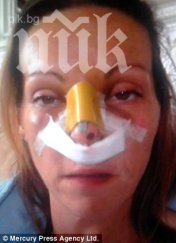 носът жена окапва операция снимки