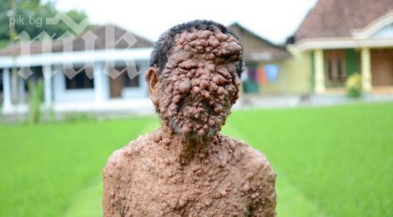 кошмар 300 тумора покриха мъж ужасяващи снимки