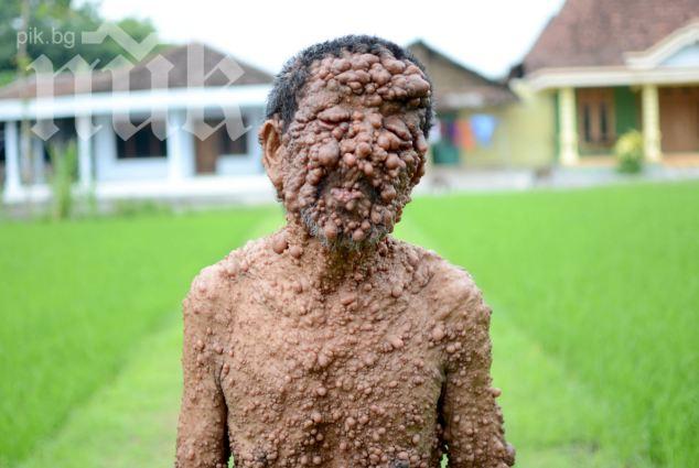 Кошмар! Над 300 тумора покриха мъж (ужасяващи снимки!)