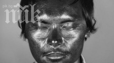 ужас вижте случва кожата излагаме твърде слънце снимки