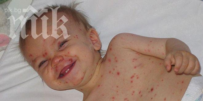 Варицела лумна в Ловешко