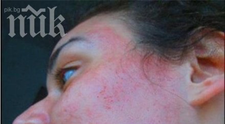 салон красота изгори лицето жена снимки