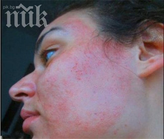 Салон за красота изгори лицето на жена (снимки)