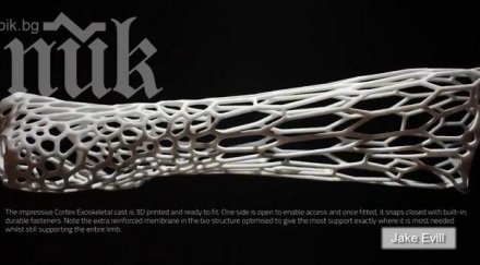 гипсова отливка лекува помощта ултразвук видео