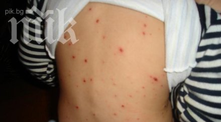 случаи варицела ловешко