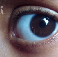 Огромен червей порасна в окото на дете! Извадиха го със сложна операция (снимки 18+)