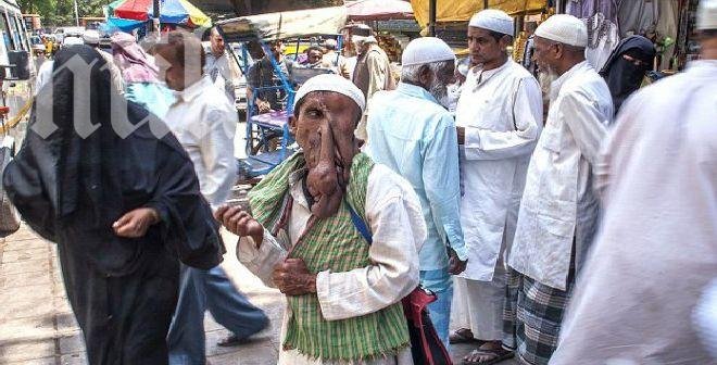 Човекът-слон отказа ново лице, за да плати сватбата на дъщеря си (снимки 18+)