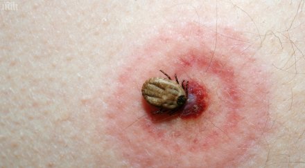 налазиха кърлежи кашлица разстройство върлуват страната