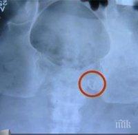 Скандална немарливост! Жена живее 20 г. със 100 марли в корема. Вадят ги и забравят инструмент