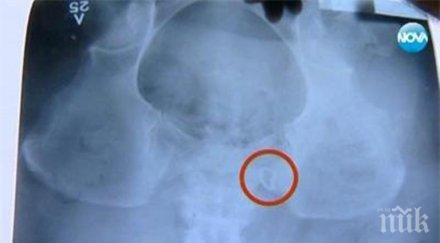 скандална немарливост жена 100 марли корема вадят забравят инструмент