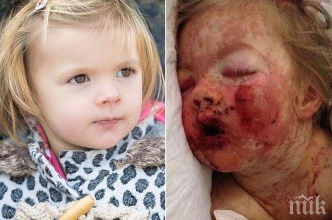  Кошмар! Нурофен съсипа 2-годишно дете (снимка)