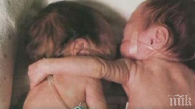 Уникално! Прегръдката, която промени медицината (снимка + видео)