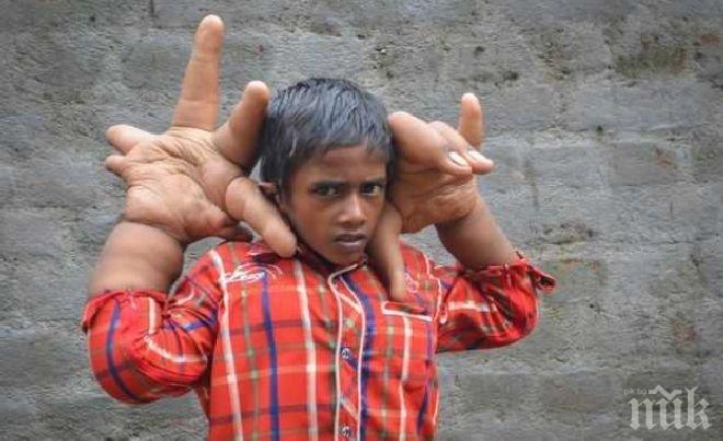 Шок! Момче с 16-килограмови ръце смая лекари (потресаващи снимки)
