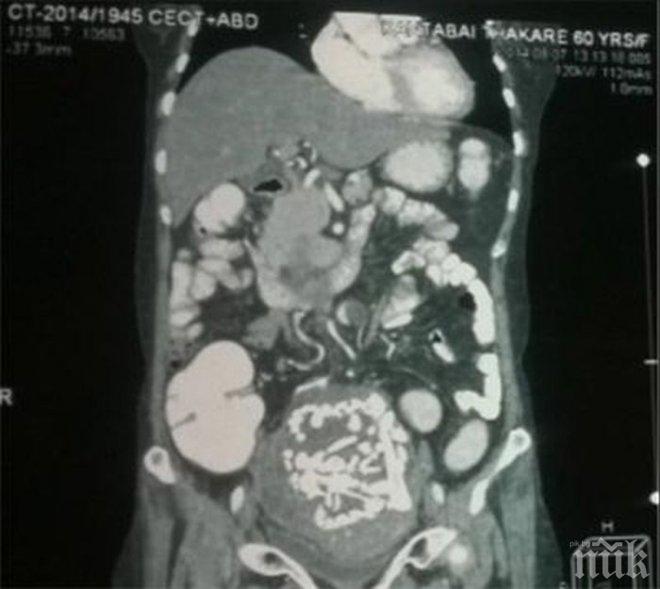 Жена живее 36 г. с ембрион в утробата си