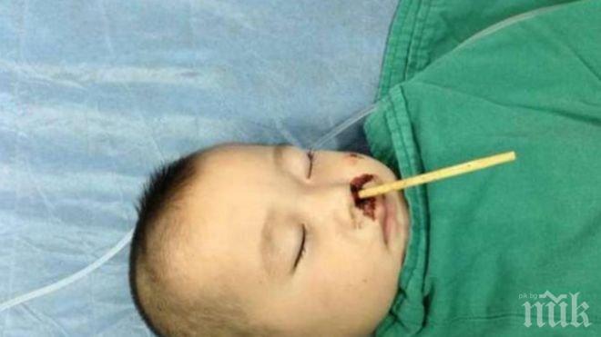 Ужас! Извадиха клечки за ядене от мозъка на дете