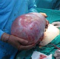 Хирурзи извадиха 20-килограмова киста от жена в Стара Загора