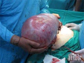 хирурзи извадиха килограмова киста жена стара загора