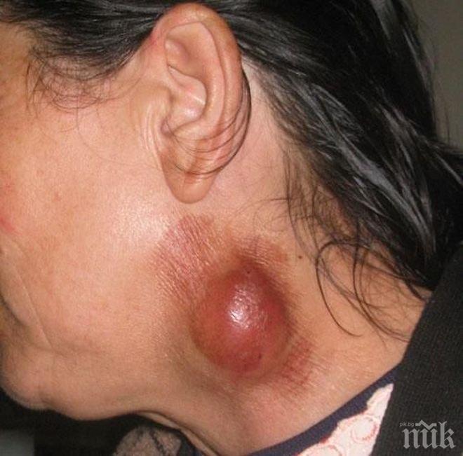 Паника от туларемия в Плевенско