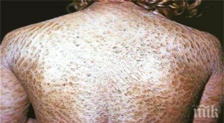 кошмар лекарства оставиха бургазлийка без кожа