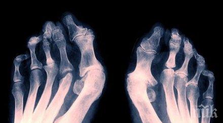 българите страдат артрит