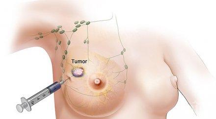 преглеждат 8000 учителки рак гърдата