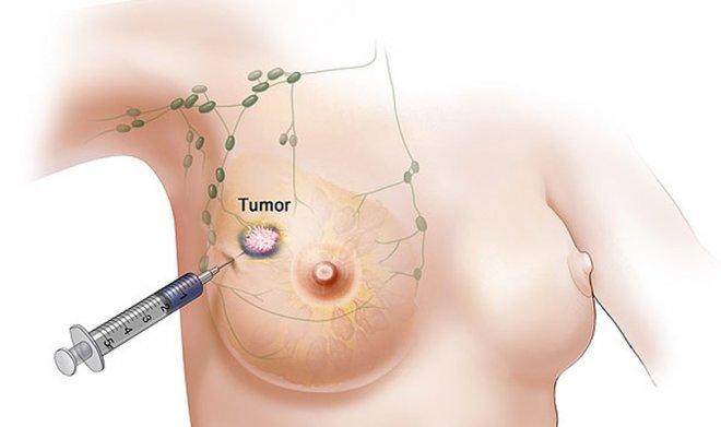 Преглеждат 8000 учителки за рак на гърдата