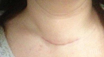 стресът липсата йод водят заболявания щитовидната жлеза