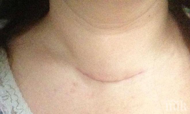 Стресът и липсата на йод водят до заболявания на щитовидната жлеза