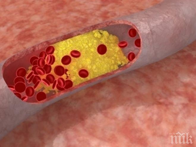 Наночастици отстранят холестеролни плаки в артериите