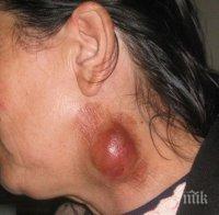 Няма регистрирани случаи на туларемия във Великотърновско
