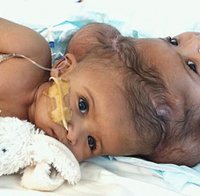 Медицинско чудо! Лекари предричат смърт след раждането на сиамски близнаци, те живеят вече 9-та година (Видео)